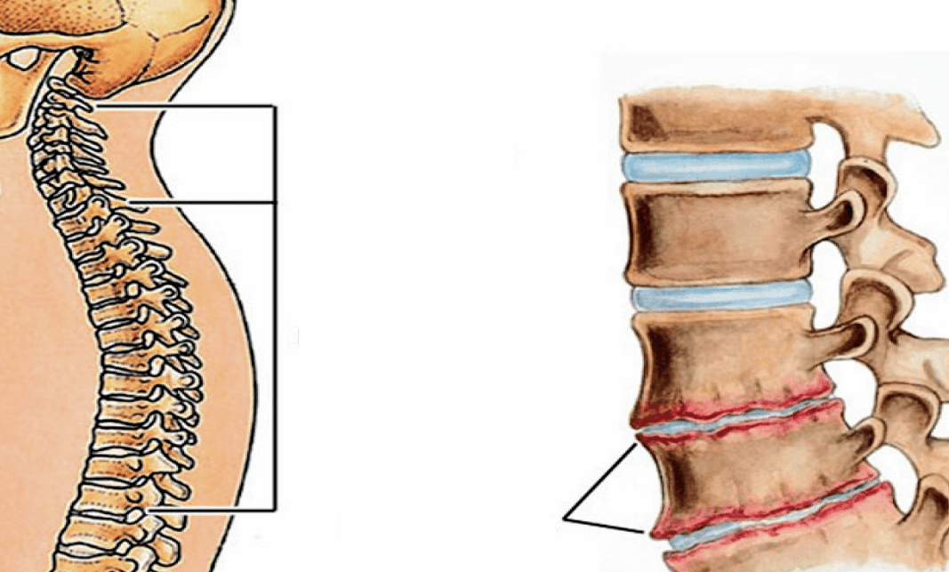 How is column osteochondrosis