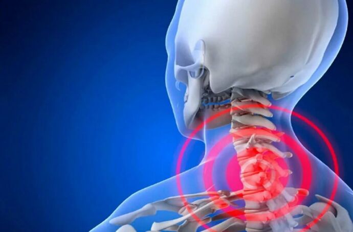 Cervical spine osteochondrosis