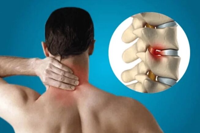 Spine osteochondrosis