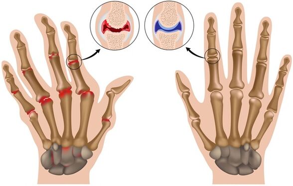 deformation of fingers due to osteoarthritis
