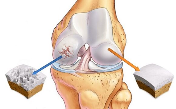 healthy cartilage and cartilage affected by osteoarthritis